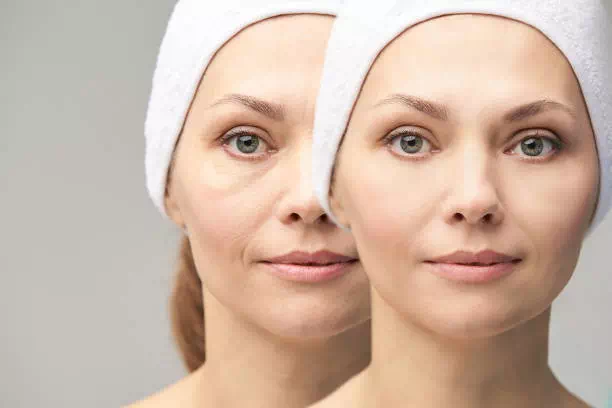 twarz kobiety przed i po zabiegu